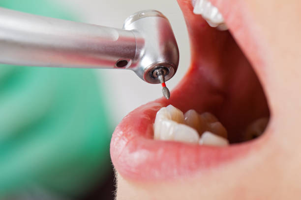 Best Emergency Tooth Extraction in Mabank, TX